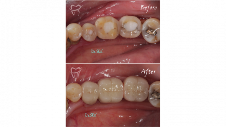 DMLS CROWN (6)