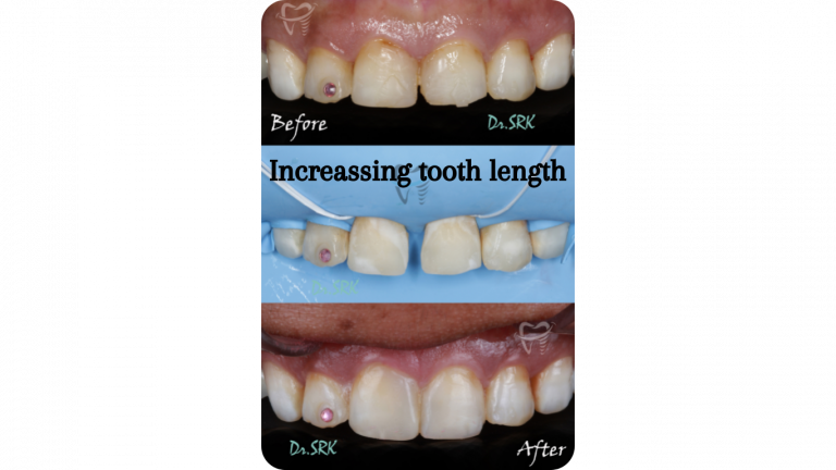 Increassing tooth length