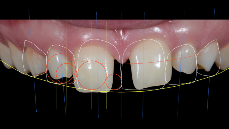 Smile designing