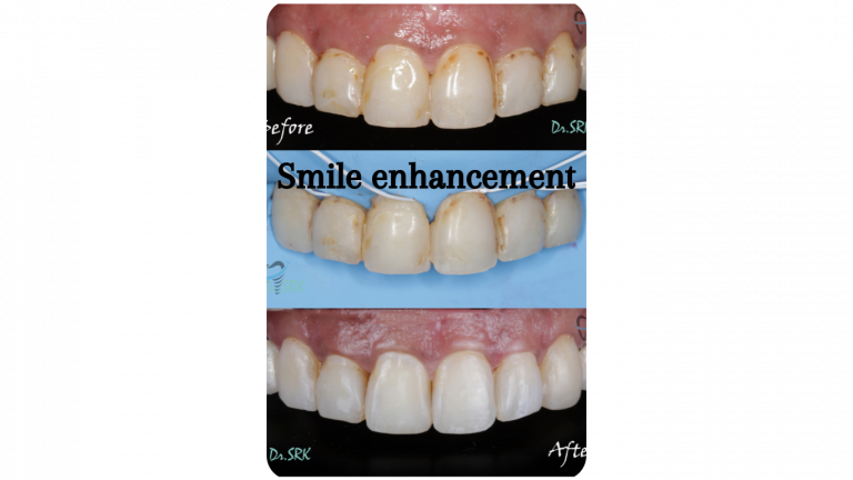 Smile enhancement