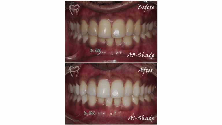 Teeth whitening (1)