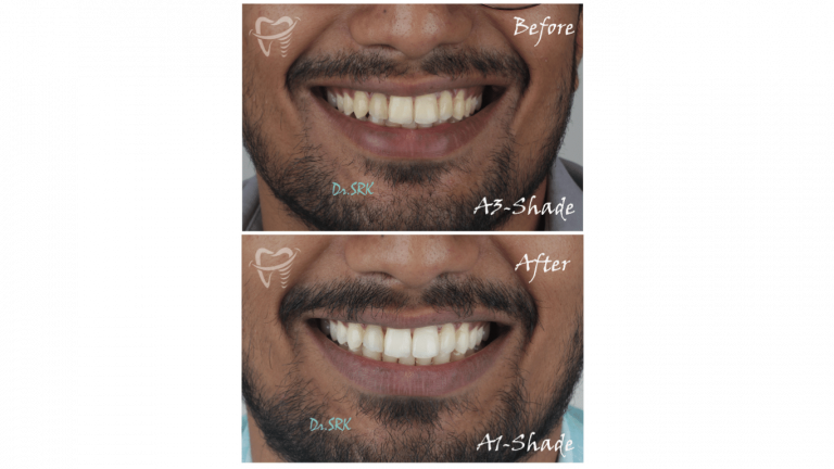 Teeth whitening (2)