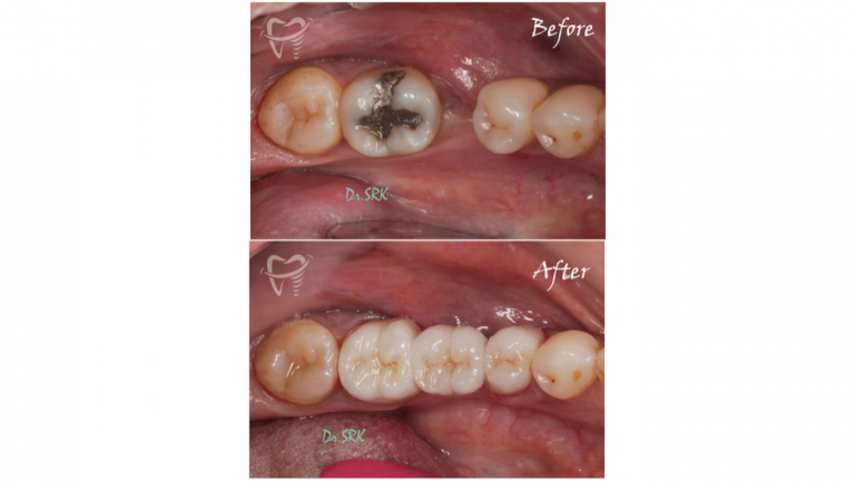 ZIRCONIA CROWN (4)