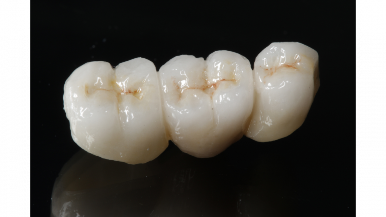 ZIRCONIA CROWN (5)