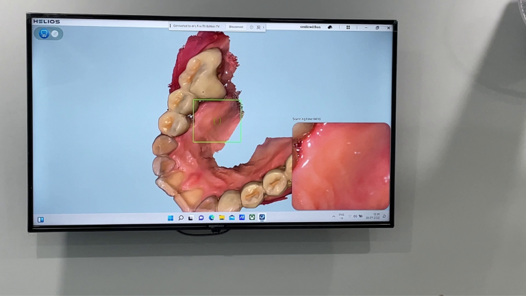 intra oral scanner