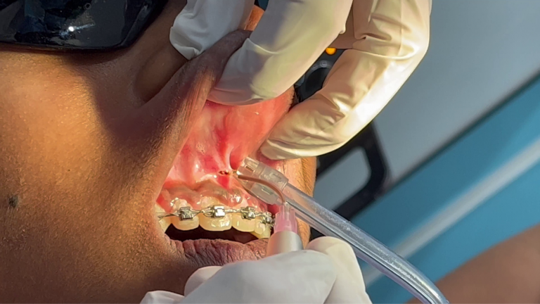 laser dentistry (3)