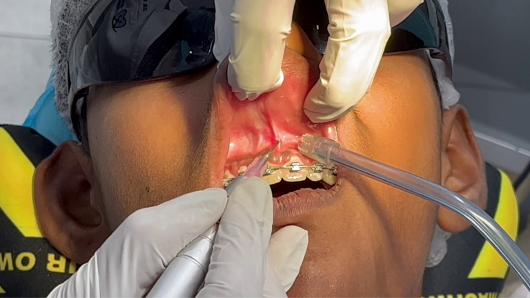 laser dentistry (4)